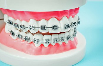 braces