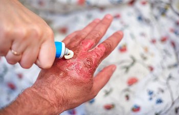 burn ointment