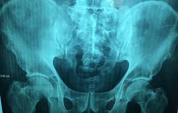 X-ray
