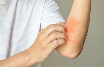 rash