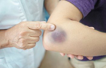 bruise