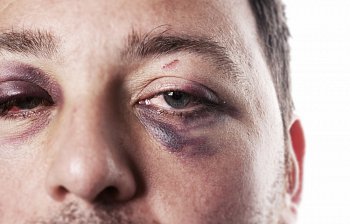 black eye
