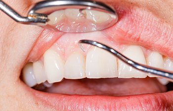 gum