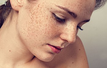 freckle