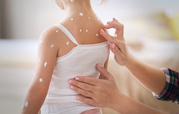 chickenpox
