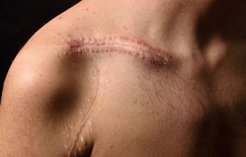 scar